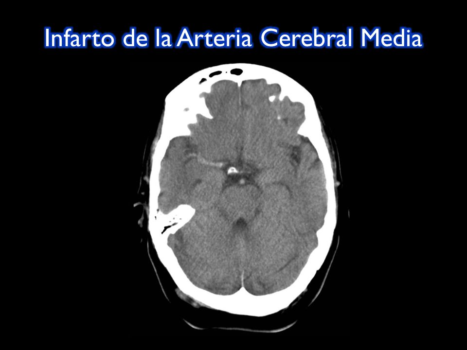 arteria cerebral media derecha sintomas de diabetes arteria cerebral media derecha sintomas de diabetes